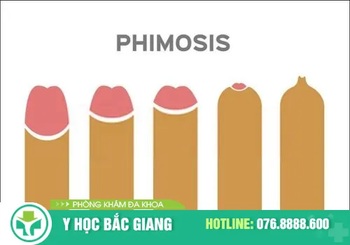 các kiểu hẹp bao quy đầu thường thấy