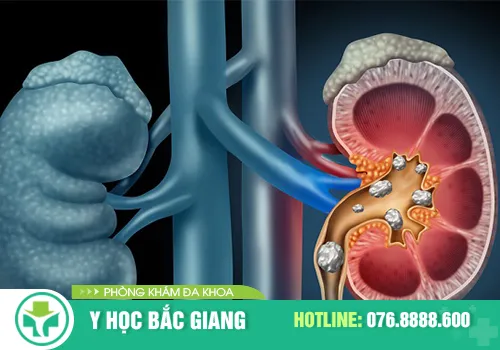 Tiểu rắt, tiểu khó cũng là dấu hiệu của bệnh sỏi thận