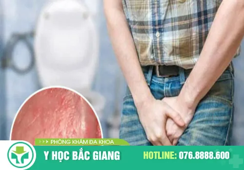 viêm bao quy đầu