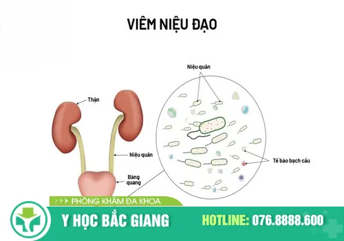 Viêm niệu đạo không chữa trị kịp thời sẽ gây nguy hiểm cho bệnh nhân